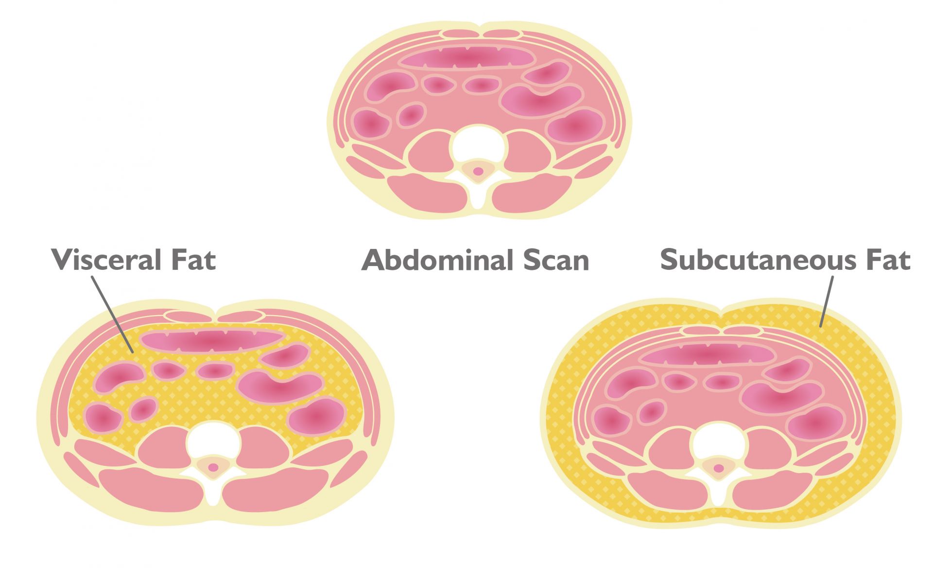 Abdominal Fat